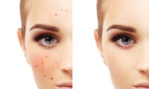 Acne Free 10 Best Acne Free Products 2024: Acne Control Products that WORK