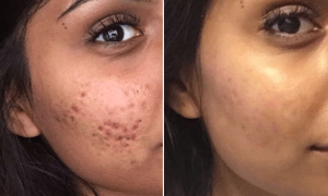 image 51 How to Get Rid of Your Cystic Acne Permanently