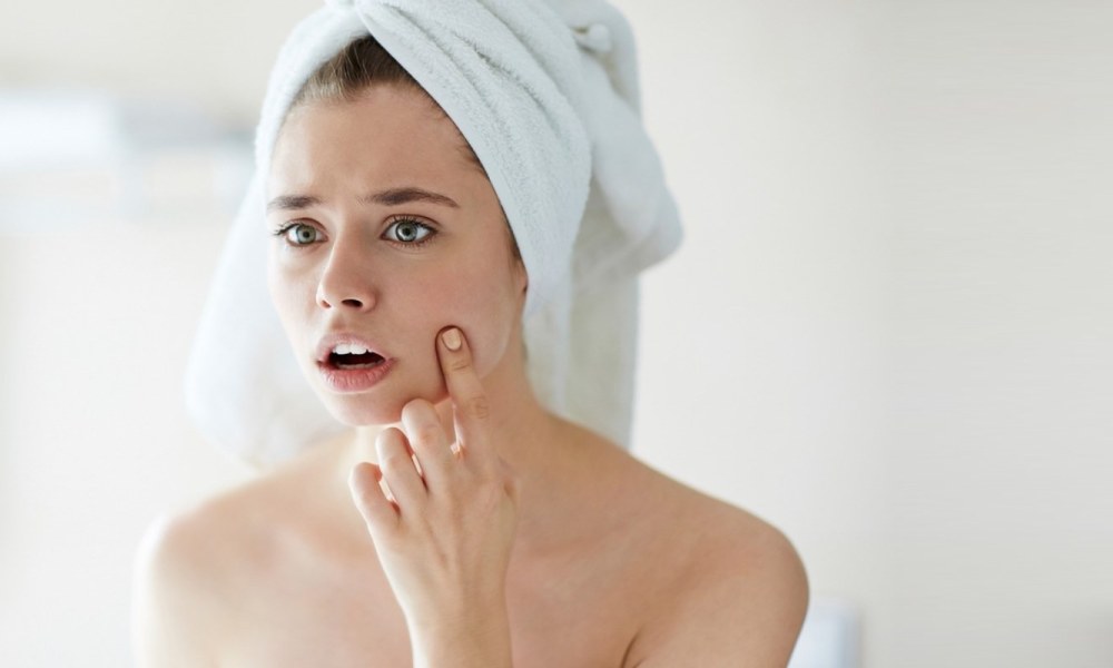 Get Rid of Acne Prevent Acne 10 Tips On How to Prevent Acne - Best Ways to Get Rid of Acne