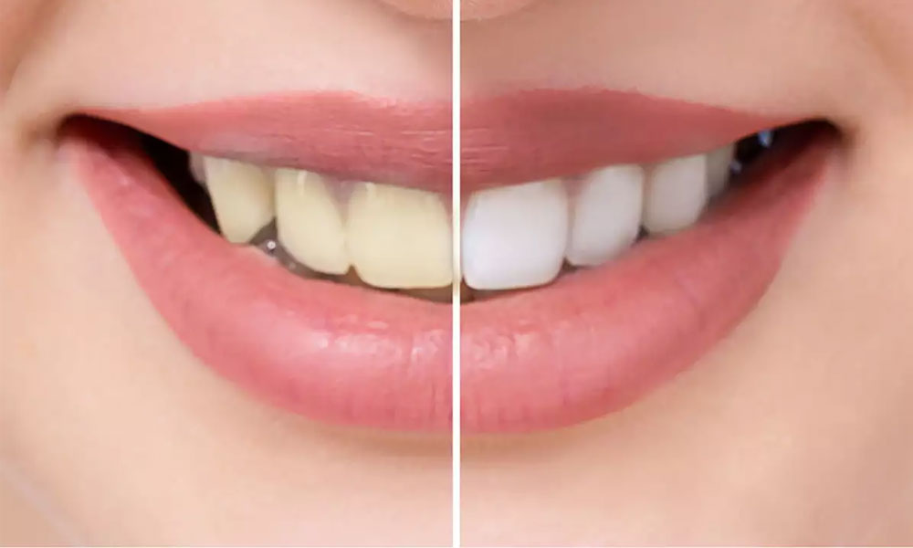 Whiten Your Teeth Naturally